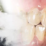 Woman showing tooth damage caused by vaping with visible dark marks on front teeth