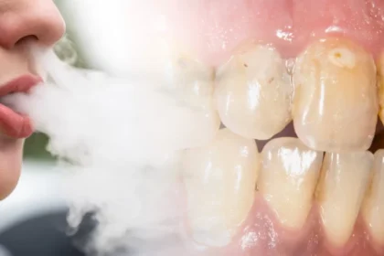 Woman showing tooth damage caused by vaping with visible dark marks on front teeth