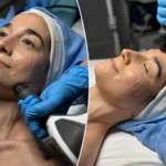 Woman receives salmon sperm DNA skin injection at Seoul aesthetic clinic, close-up on targeted facial treatment.