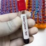 Colorectal cancer blood test detects precancerous colon lesions in new study